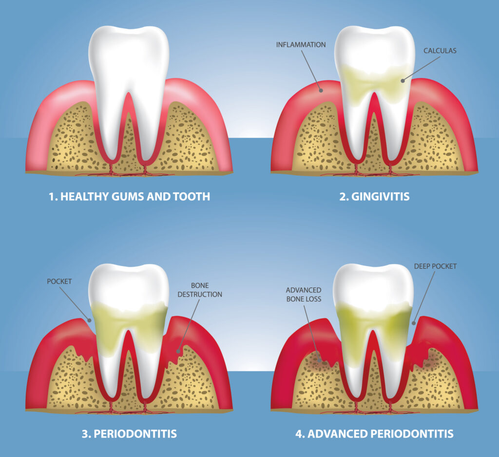 Gum Disease Diagram